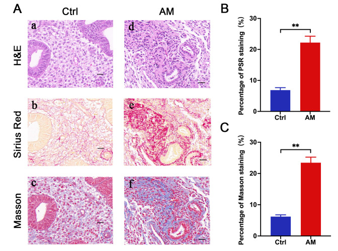 The matrix stiffness is increased in the eutopic endometrium of adenomyosis patients: a study based on atomic force microscopy and histochemistry.