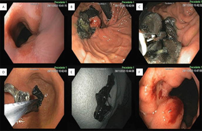 ENDOSCOPIC MANAGEMENT OF MESH MIGRATION FOLLOWING HIATAL HERNIA REPAIR.
