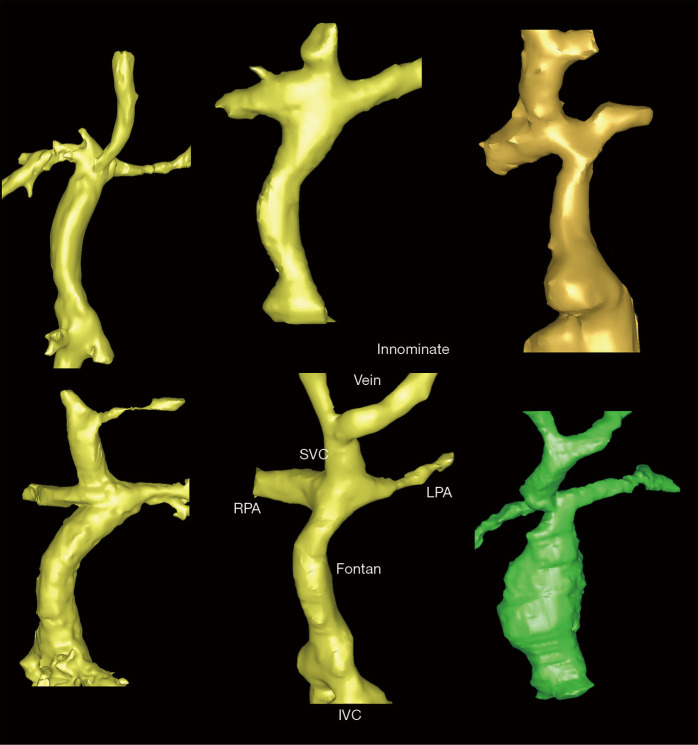 Greater than the sum of its parts: multimodality imaging in adults with congenital heart disease.