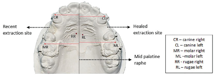Timing of Therapeutic Extractions Can Affect En Masse Anterior Retraction: A Split Mouth Randomized Clinical Trial.