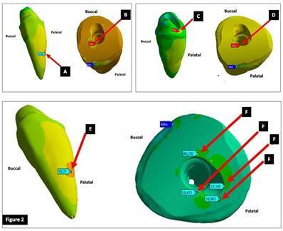 Comparative finite element analyses of stress exerted on the dentin by intraradicular posts.
