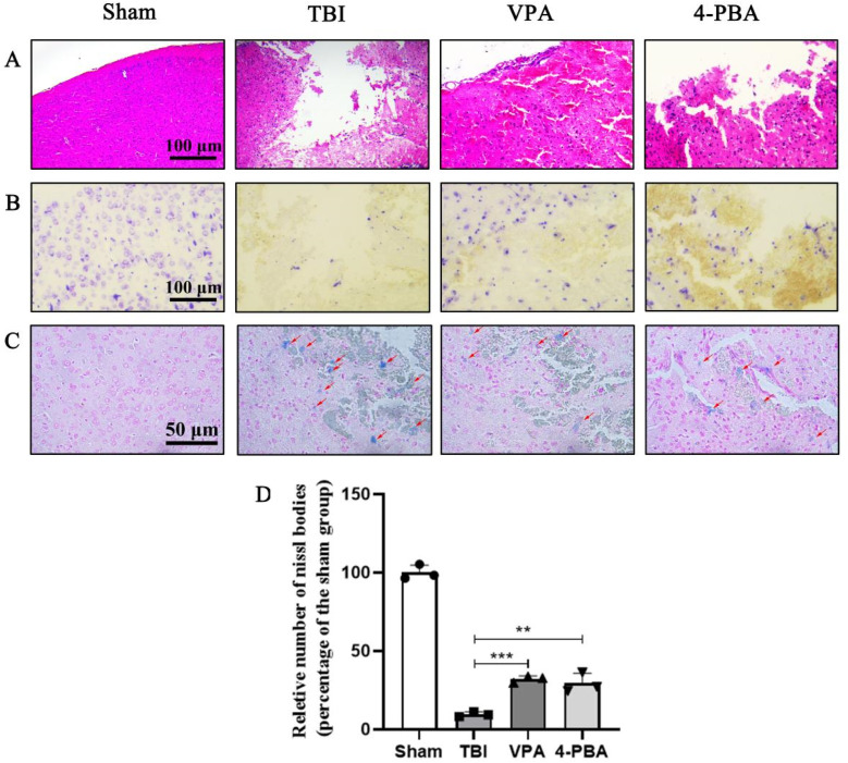 Valproic Acid Inhibits Endoplasmic Reticulum Stress and Reduces Ferroptosis After Traumatic Brain Injury.