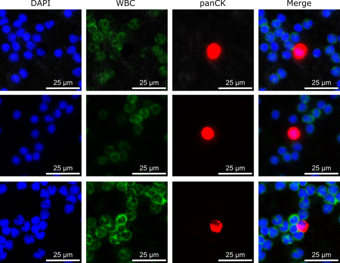 Multi-marker analysis of circulating tumor cells in localized intermediate/high-risk and metastatic prostate cancer.