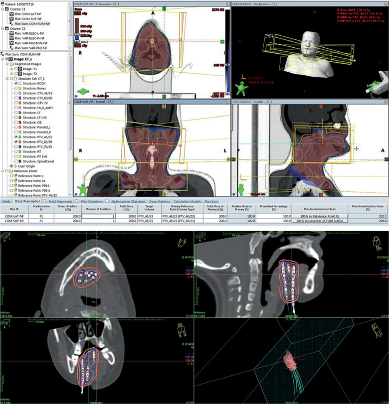 Efficacy of adjuvant external beam radiotherapy and brachytherapy in squamous cell carcinoma of oral tongue: Long-term outcomes.