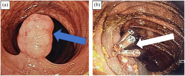 An Unusual Diagnosis of Rectosigmoid Leiomyoma in an Adult: A Rare Case Report.