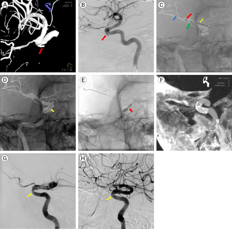 Use of a new low-profile coronary stent graft for the treatment of intracranial carotid blow-out.