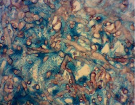 Mucormycosis Causing Splenic Infarction, Gastric Fistula, and Brain Abscess in a Patient With Acute Myeloid Leukemia: A Case Report.