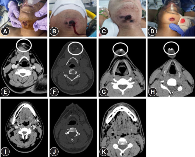 Injuries from blank cartridge shots in suicide attempts within the South Korean military: a case series of five patients.