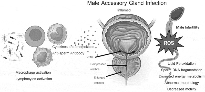 Male accessory gland infection (MAGI): Over-diagnosed or under treated in infertile men?