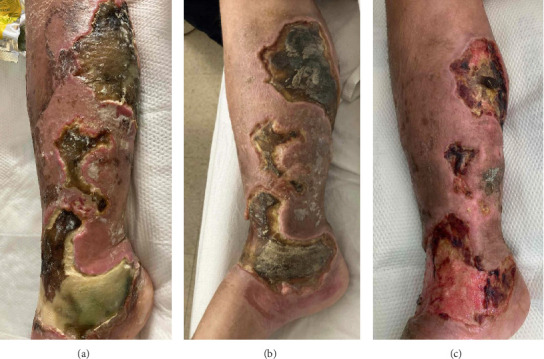 Two Cases of Maggot-Associated <i>Ignatzschineria</i> Bacteremia in Xylazine-Induced Injection Wounds: An Emerging Threat.