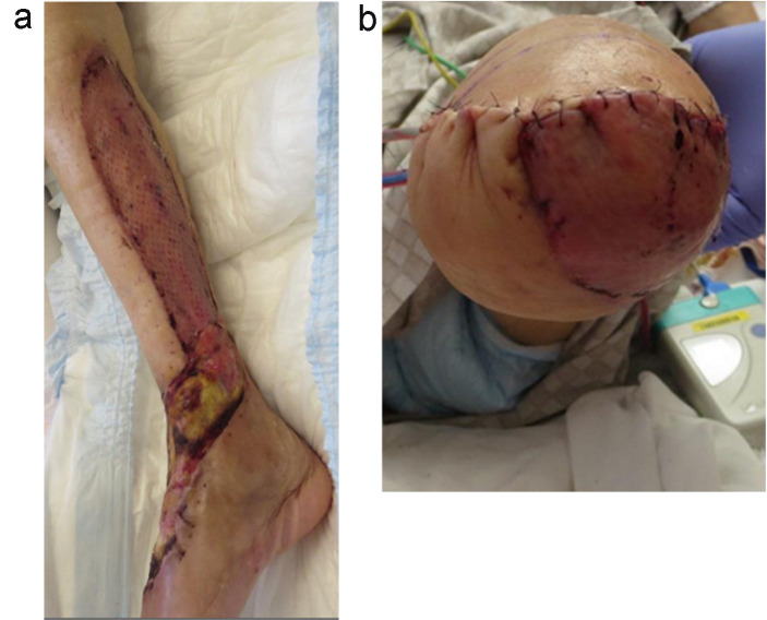 Prosthetic Gait Achievement in an Elderly Patient with Chronic Limb-threatening Ischemia and High Complications Using a Novel Lipoprotein Apheresis.