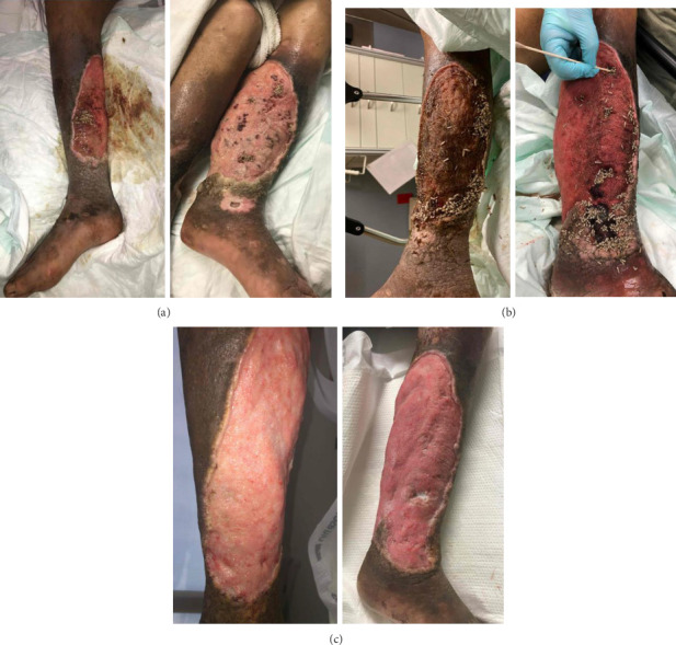 Two Cases of Maggot-Associated <i>Ignatzschineria</i> Bacteremia in Xylazine-Induced Injection Wounds: An Emerging Threat.
