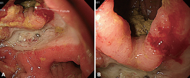 [Gastrojejunocolic Fistula: A Late Complication After Gastrojejunostomy].