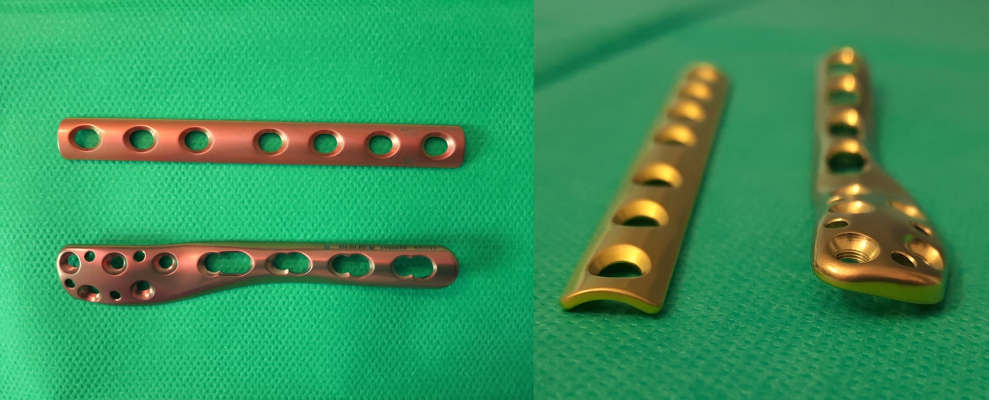 Modern anatomical locking plates are associated with increased postoperative wound complications and unplanned surgical revisions compared to standard tubular plates in the management of unstable ankle fractures: a comparative cohort study in 595 patients.