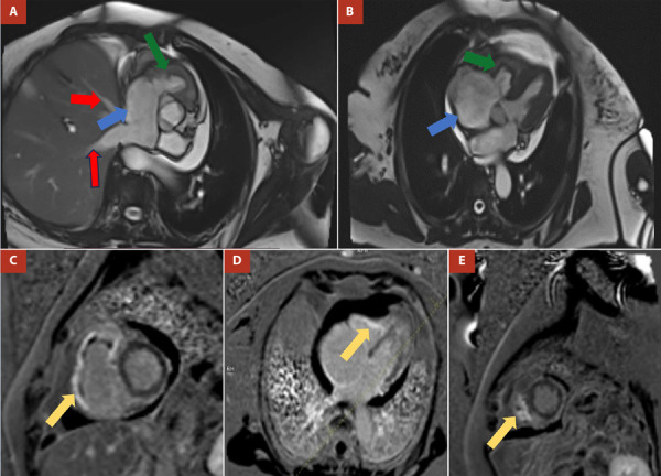 [Right ventricular endomyocardial fibrosis: Atypical presentation of a rare disease. Case report].