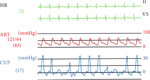Arrhythmia Induced by Positional Change Under General Anesthesia Related to Caudal Movement of the Peripherally Inserted Central Venous Catheter: A Case Report.