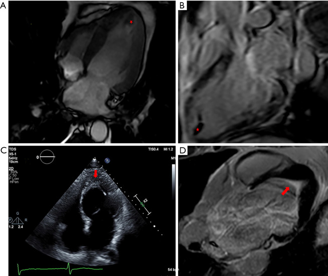 The Cleveland Clinic experience of eosinophilic myocarditis in the setting of hypereosinophilic syndrome: demographics, cardiac imaging, and outcomes.