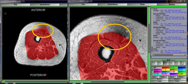 Fully-automated segmentation of muscle and inter-/intra-muscular fat from magnetic resonance images of calves and thighs: an open-source workflow in Python.