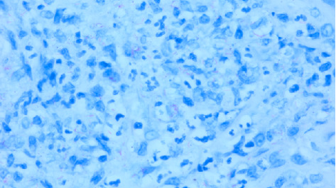 Unusual Presentation of Extrapulmonary Tuberculosis as Laryngeal Mass in an Atypical Patient.