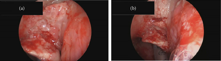 Unusual Presentation of Extrapulmonary Tuberculosis as Laryngeal Mass in an Atypical Patient.