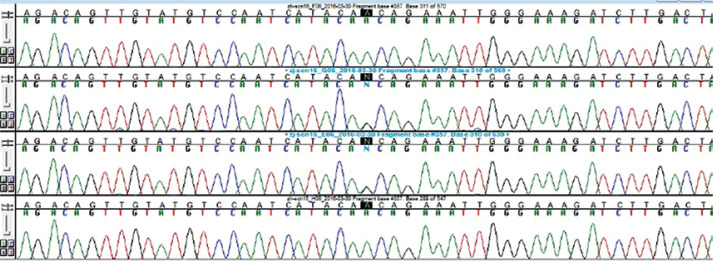 Migrainous stroke in a male patient with familial hemiplegic migraine.