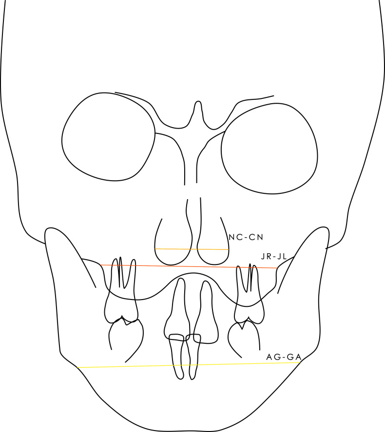 Association between dental agenesis and facial morphology. A cross-sectional study in France.
