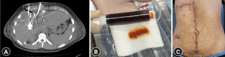 A starry night: a case report of severe liver injury due to a close-range shotgun blast in Argentina.
