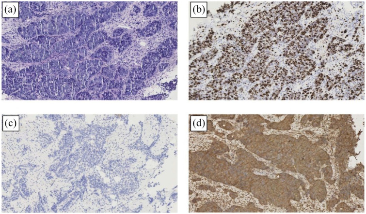 Ectopic corticotropin-releasing hormone syndrome caused by rectal large cell neuroendocrine carcinoma: a rare case report.