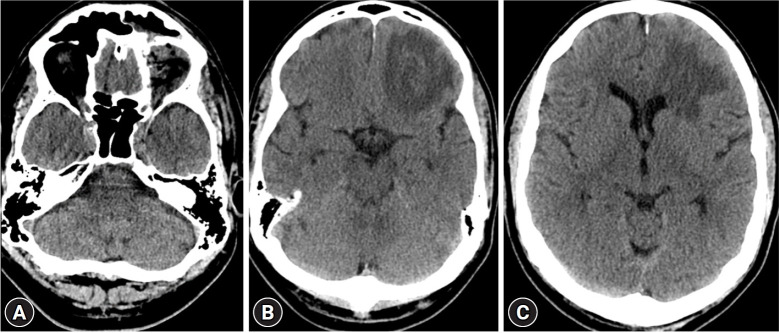 Endoscopic transorbital approach for the removal of a frontal lobe foreign body: a case report.