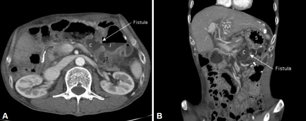 [Gastrojejunocolic Fistula: A Late Complication After Gastrojejunostomy].