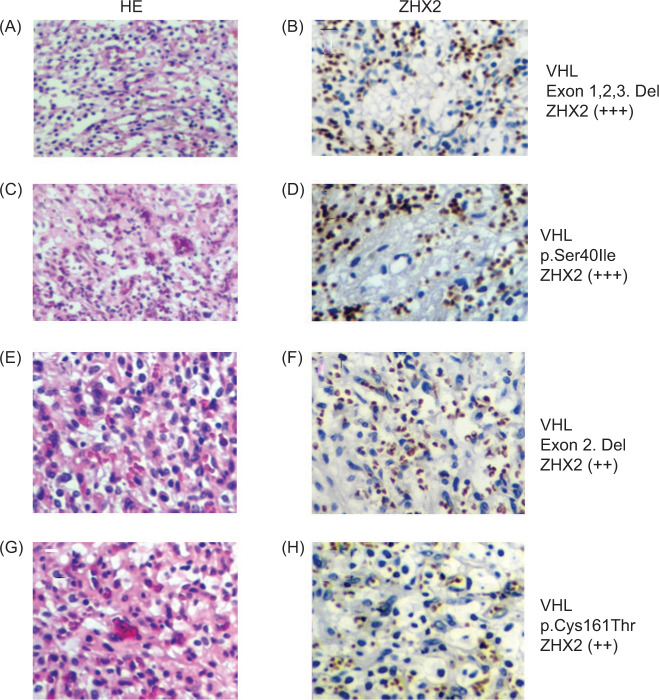 Relationship between ZHX2 Expression and VHL Gene Alteration in VHL-associated and Sporadic Hemangioblastomas of the Central Nervous System.