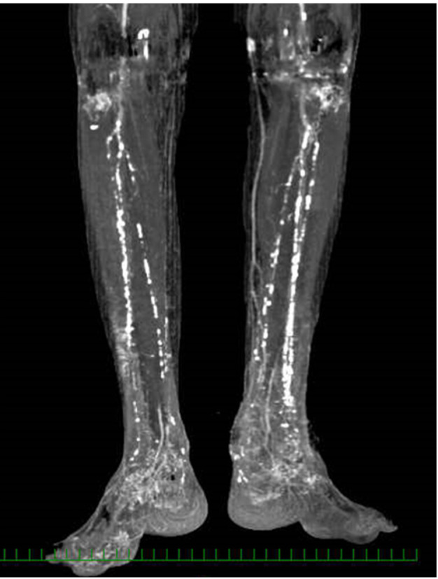 Prosthetic Gait Achievement in an Elderly Patient with Chronic Limb-threatening Ischemia and High Complications Using a Novel Lipoprotein Apheresis.