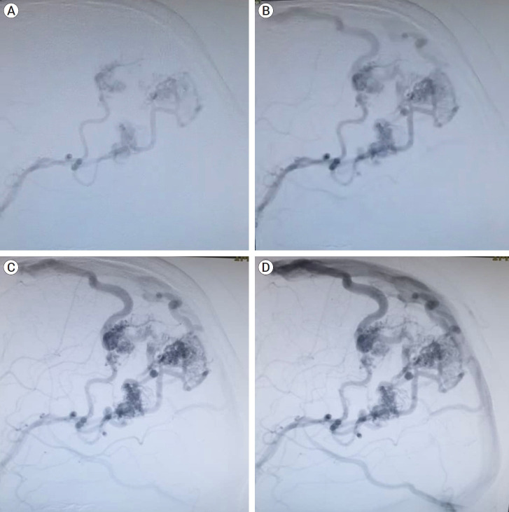 Multiple AVM with separate nidi, a case report and review the literatures.