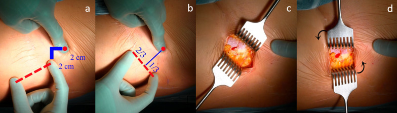 For many but not for all: the bikini incision direct anterior approach for total hip arthroplasty. A narrative review.