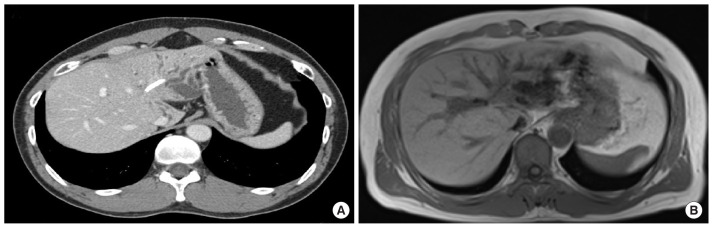 Long-term tumor suppression in cholangiocarcinoma using cytokine-induced killer cell therapy and high-dose vitamin C: a case report.