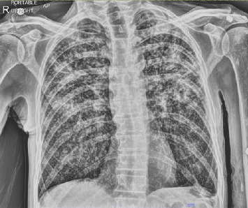Unusual Presentation of Extrapulmonary Tuberculosis as Laryngeal Mass in an Atypical Patient.