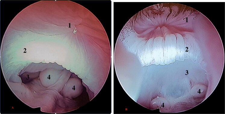 Endoscopic techniques for early diagnosis of cloacal pathologies and sex determination in blue spotted tree monitor (<i>Varanus macraei)</i> and Cuming's water monitor (<i>Varanus cumingi)</i>.