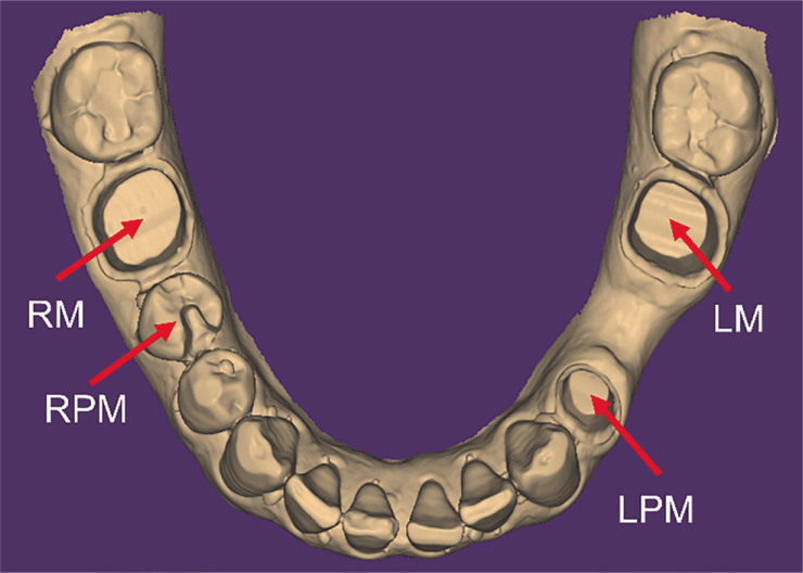 Effect of scan path on accuracy of complete arch intraoral scan.