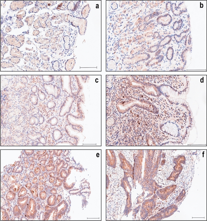 Differential expression of the ubiquitin-editing enzyme A20 in gastric biopsies indicates the severity of disease.