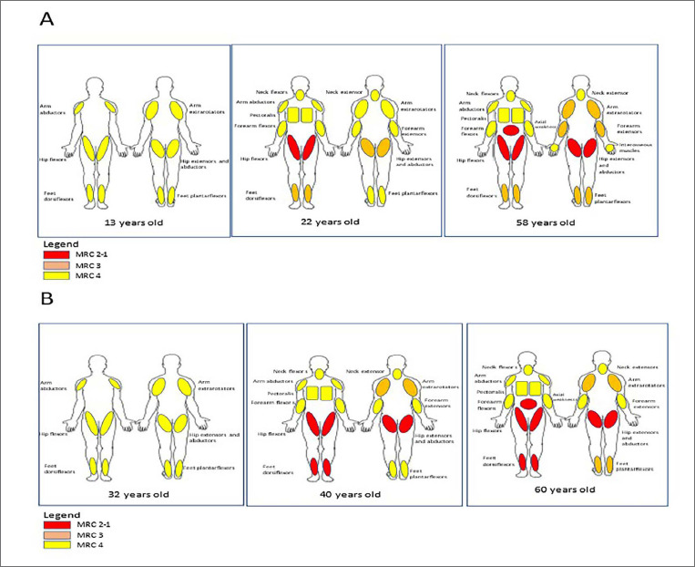 The <i>TRIM32</i> geno-phenotype spectrum: a literature review and 25-year clinical follow-up of two brothers living with sarcotubular myopathy.