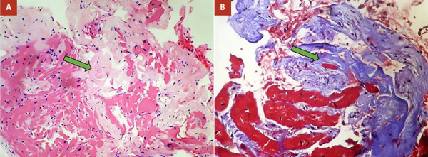 [Right ventricular endomyocardial fibrosis: Atypical presentation of a rare disease. Case report].
