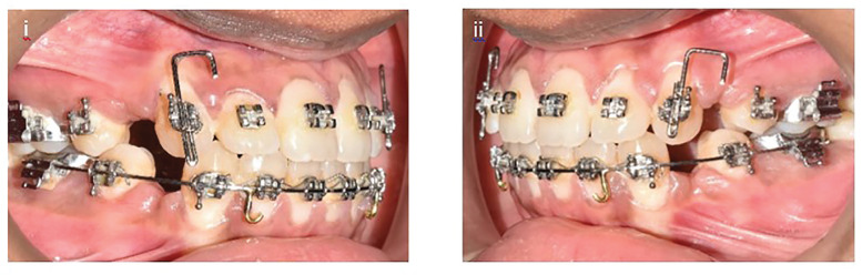 Timing of Therapeutic Extractions Can Affect En Masse Anterior Retraction: A Split Mouth Randomized Clinical Trial.