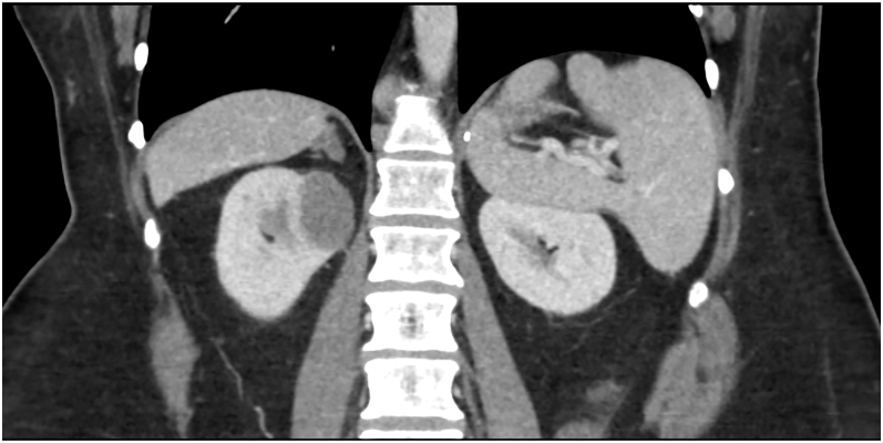 Hereditary leiomyomatosis and renal cell cancer (HLRCC), pheochromocytoma (PCC)/paraganglioma (PGL) and germline fumarate hydratase (FH) variants.