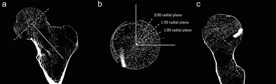 The ability of plain radiography to accurately describe the bone surface at the head-neck junction of the femur: a study using human bone models.
