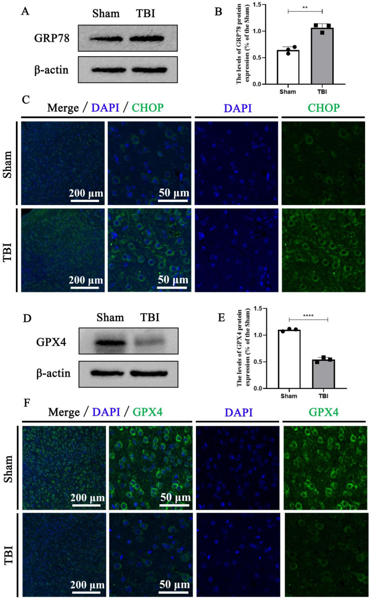 Valproic Acid Inhibits Endoplasmic Reticulum Stress and Reduces Ferroptosis After Traumatic Brain Injury.