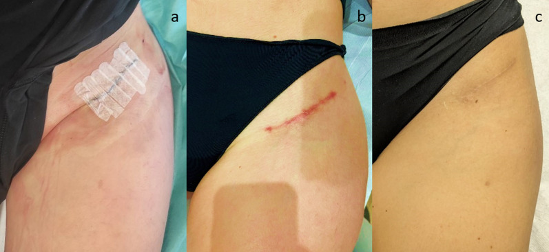 For many but not for all: the bikini incision direct anterior approach for total hip arthroplasty. A narrative review.
