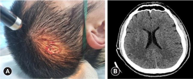 Injuries from blank cartridge shots in suicide attempts within the South Korean military: a case series of five patients.