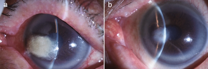 Fungal Keratitis Caused by Humicola sardiniae.