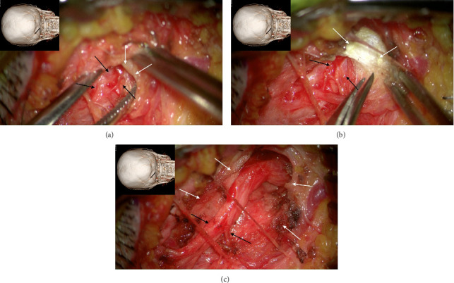 Involvement of the Ipsilateral Tongue, an Intraoral Structure of Referred Pain due to Entrapment of the Greater Occipital Nerve.