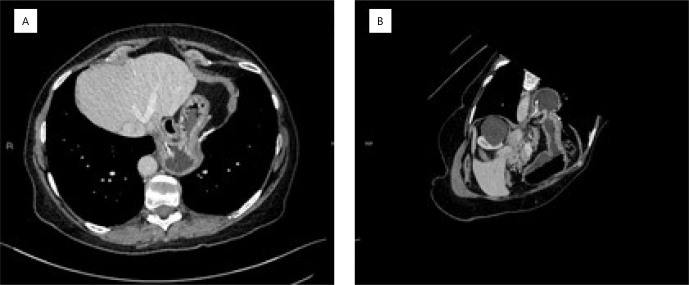 ENDOSCOPIC MANAGEMENT OF MESH MIGRATION FOLLOWING HIATAL HERNIA REPAIR.